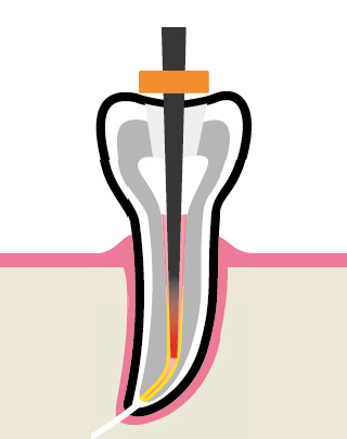 Вертикальная конденсация - этап 3 удаления излишков